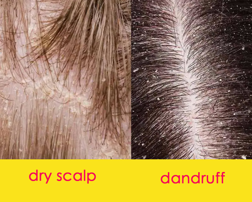 treating-dandruff-pelo-hairdressing